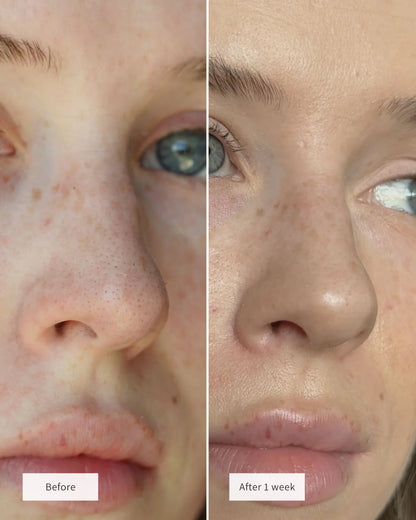 Hydrocolloid™ Nose Strips