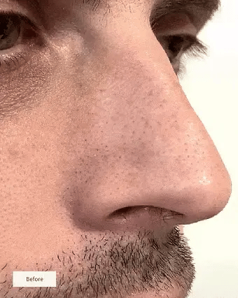Hydrocolloid™ Nose Strips